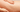 PRP gegen Cellulite?