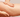PRP gegen Cellulite?